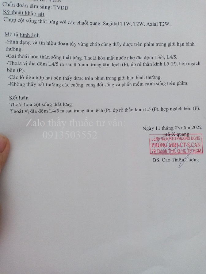 Thoát vị đĩa đệm l4 l5